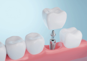 Digital depiction of a dental implant being placed into an empty socket in the mouth.