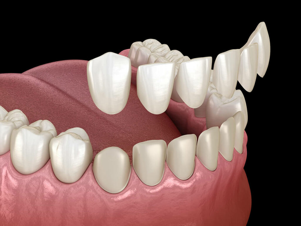Digital depiction of veneers being placed over teeth