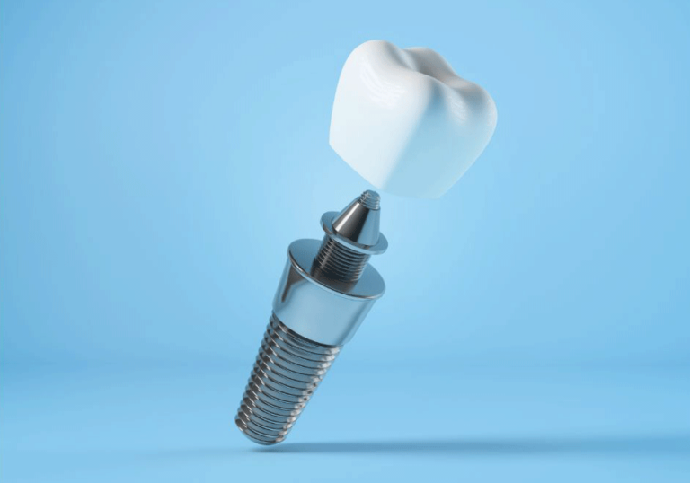 Stock photo of a dental implant