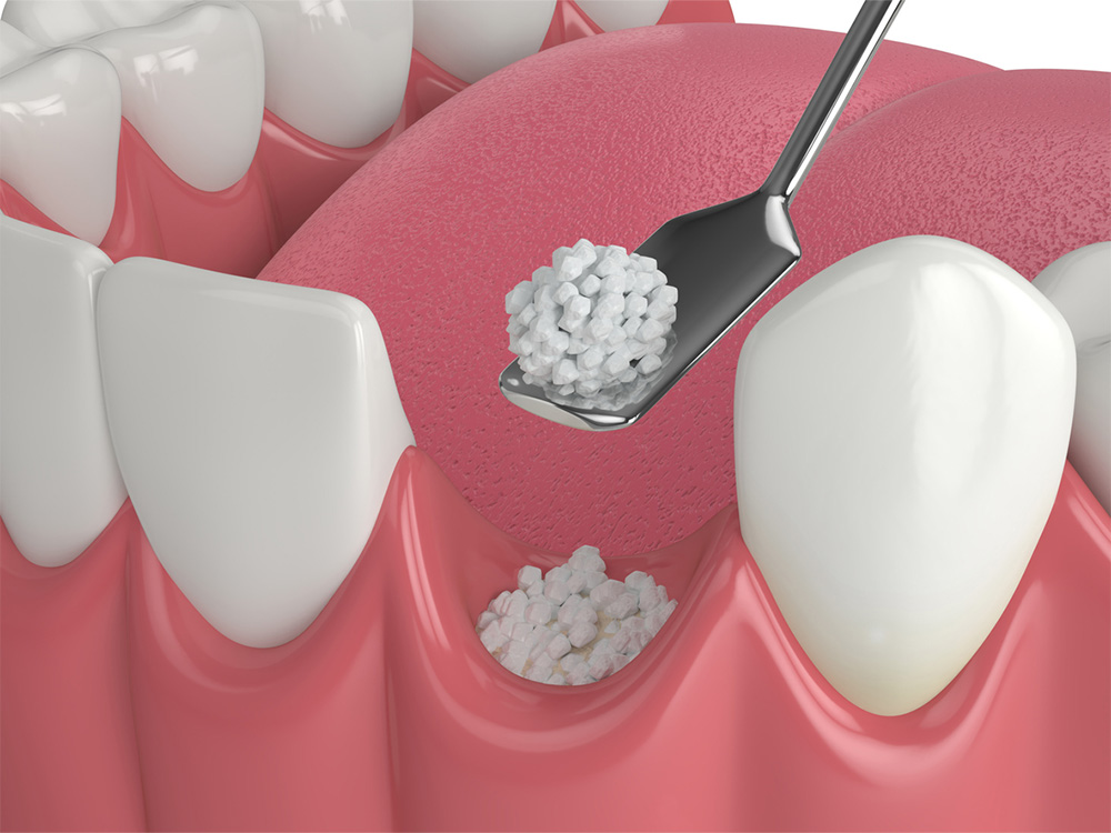 Digital depiction of a dental bone grafting procedure.