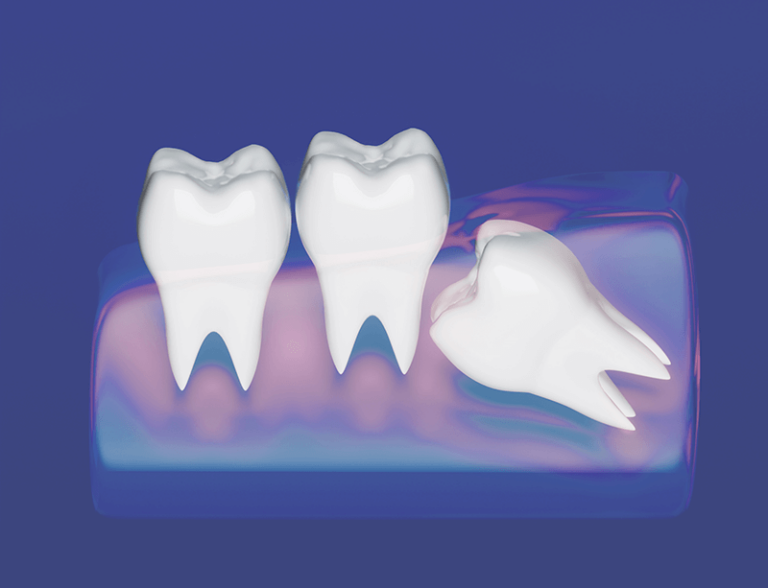 Digital depiction of an impacted wisdom tooth pushing against other teeth in the mouth.
