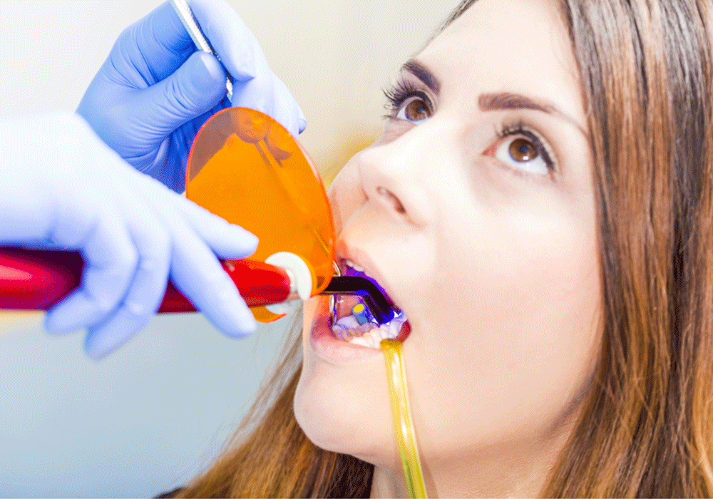Patient receiving a dental bonding treatment that is being set with UV light.
