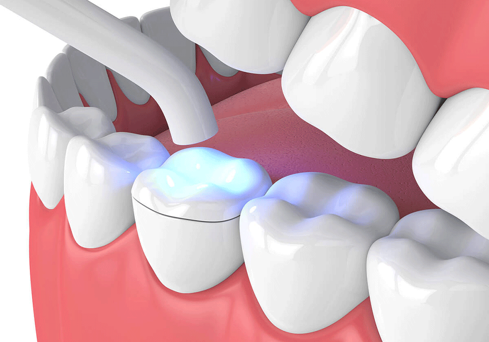 Digital depiction of a dental inlay being set with UV light.