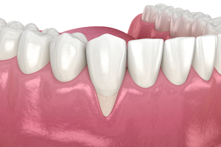 3D illustration of dental health care showing a close-up view of a dental probe checking gum health near the lower molars, emphasizing the need for gum disease treatment, set against a pink gum background.